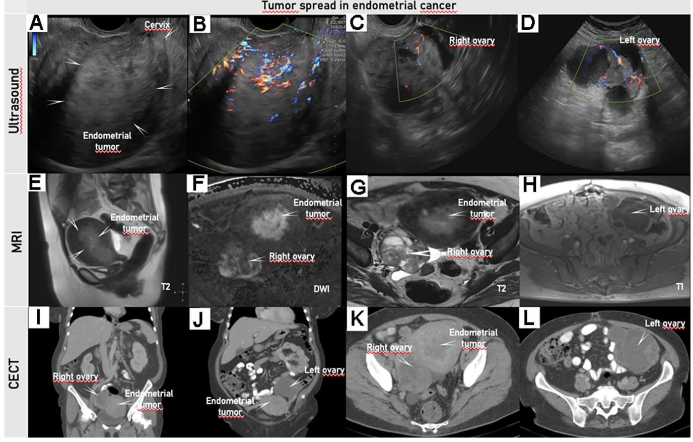 【Staging by imaging in gynecologic cancer and the role of ultrasound: an update of European joint consensus statements】Ultrasound, MRI, CT