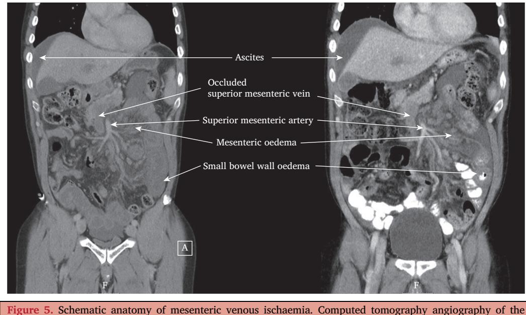 【European Society for Vascular Surgery (ESVS) 2025 Clinical Practice Guidelines on the Management of Diseases of the Mesenteric and Renal Arteries and Veins】Computed Tomography Angiography (CTA)