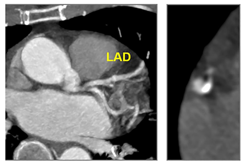 【CAD-RADS™ 2.0 - 2022 冠状动脉疾病 - 报告和数据系统的专家共识】Coronary Computed Tomography Angiography (CCTA)