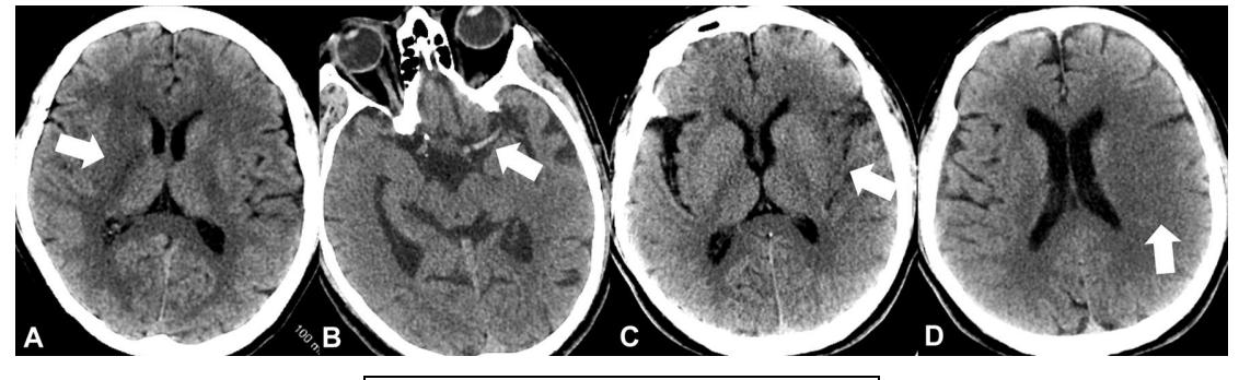 image_category: MEDICAL_IMAGING/头部CT平扫 | body_region: 头 | specialty: 神经内科/放射科 | summary: 头部CT平扫显示急性缺血性脑卒中的早期影像学征象,包括大脑中动脉高密度征及局部脑实质低密度改变。