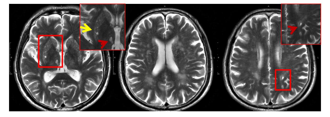 【中国脑卒中防治指导规范(2021年版)】磁共振成像 (MRI)