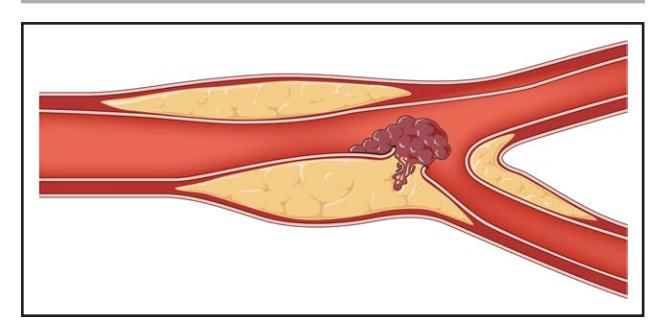 image_category: DIAGRAM/Pathophysiology Illustration | body_region: NA | specialty: Cardiology | summary: Illustration showing atherosclerotic plaque rupture and subsequent thrombus formation leading to arterial occlusion. | detail: This medical illustration provides a detailed cross-sectional view of an artery undergoing pathological changes associated with advanced atherosclerosis. The primary visual elements include the red arterial walls and the central lumen through which blood flows. Along the inner lining, prominent yellow masses represent atherosclerotic plaques, composed of cholesterol, calcium, and cellular debris. These plaques are shown protruding into the lumen, causing significant narrowing or stenosis. A key focal point of the image is the rupture of the plaque's surface. At this site of injury, a large, dark red, lobulated thrombus (blood clot) has developed. The thrombus is shown partially obstructing the remaining passage, illustrating how a sudden clot formation can lead to acute ischemia. The vessel is shown branching into two smaller arteries on the right, a common site for plaque accumulation due to hemodynamic stress. This illustration is clinically significant as it demonstrates the mechanism behind acute coronary syndromes and strokes, where the transition from a stable plaque to an unstable, ruptured one leads to sudden vessel occlusion. The contrast between the smooth vessel wall and the irregular, obstructive plaque and thrombus highlights the severity of the vascular compromise and the risk of total embolic or thrombotic blockage. | entities: diseases=Atherosclerosis, Thrombosis, Arterial stenosis, Plaque rupture, Ischemia; anatomical_structures=Artery, Arterial wall, Lumen, Vessel bifurcation; biomarkers=Lipid core, Fibrous cap; findings=Yellow atherosclerotic plaque, Ruptured fibrous cap, Intraluminal thrombus, Narrowed arterial lumen
