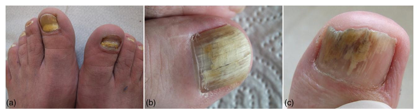 image_category: CLINICAL_PHOTO/Clinical photograph | body_region: limb | specialty: Dermatology | summary: Clinical photograph showing severe onychomycosis with nail thickening, yellow-brown discoloration, and subungual hyperkeratosis.