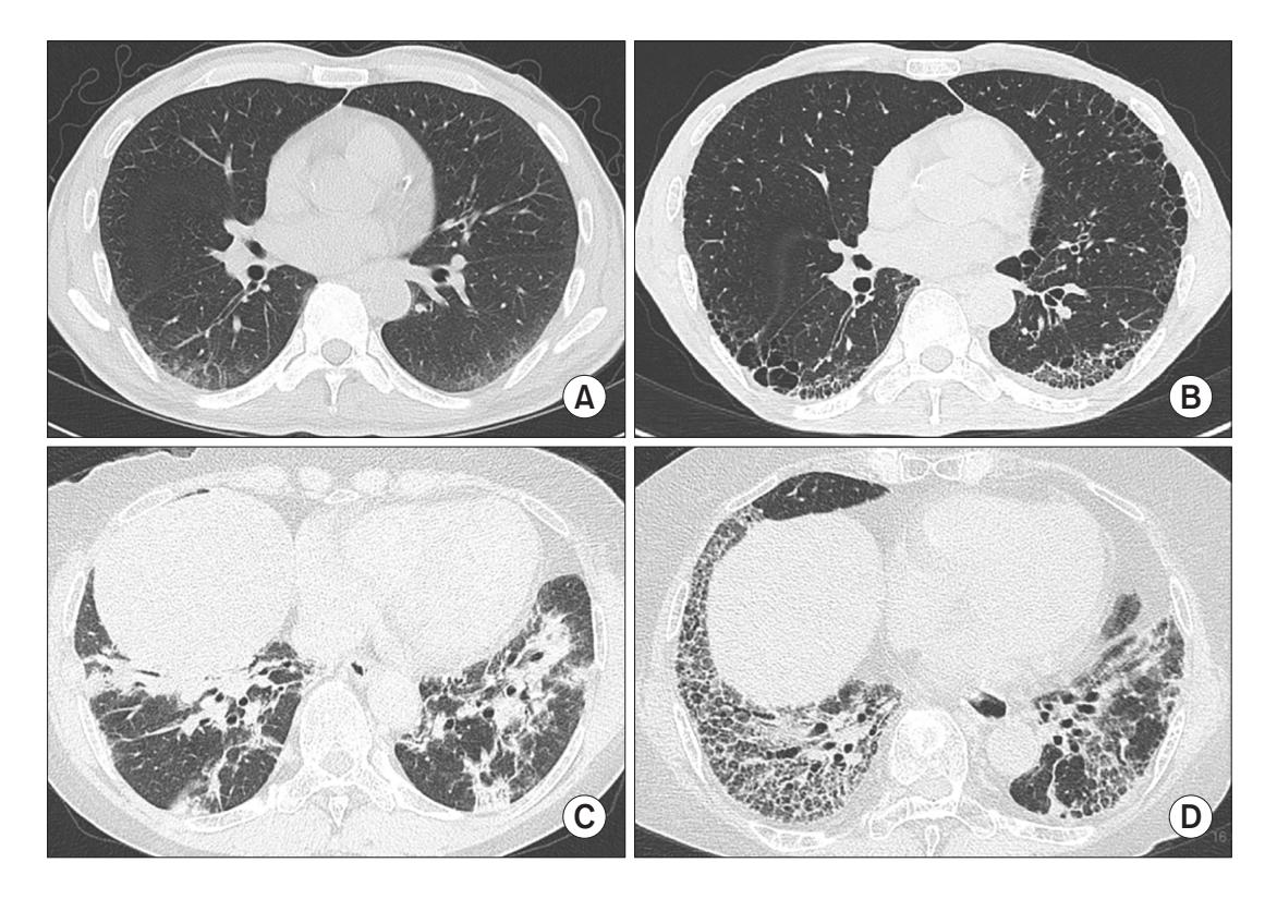 【Korean Guidelines for Diagnosis and Management of Interstitial Lung Diseases】HRCT