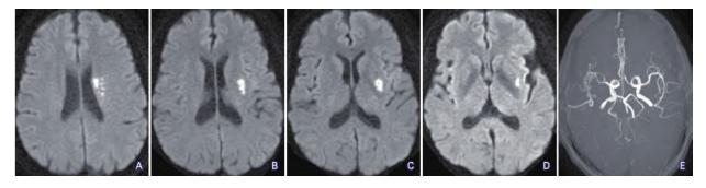 image_category: MEDICAL_IMAGING/MRI (DWI & MRA) | body_region: 头 | specialty: 神经内科/放射科 | summary: 左侧基底节区及放射冠急性脑梗死,伴左侧大脑中动脉分支血流信号减弱。
