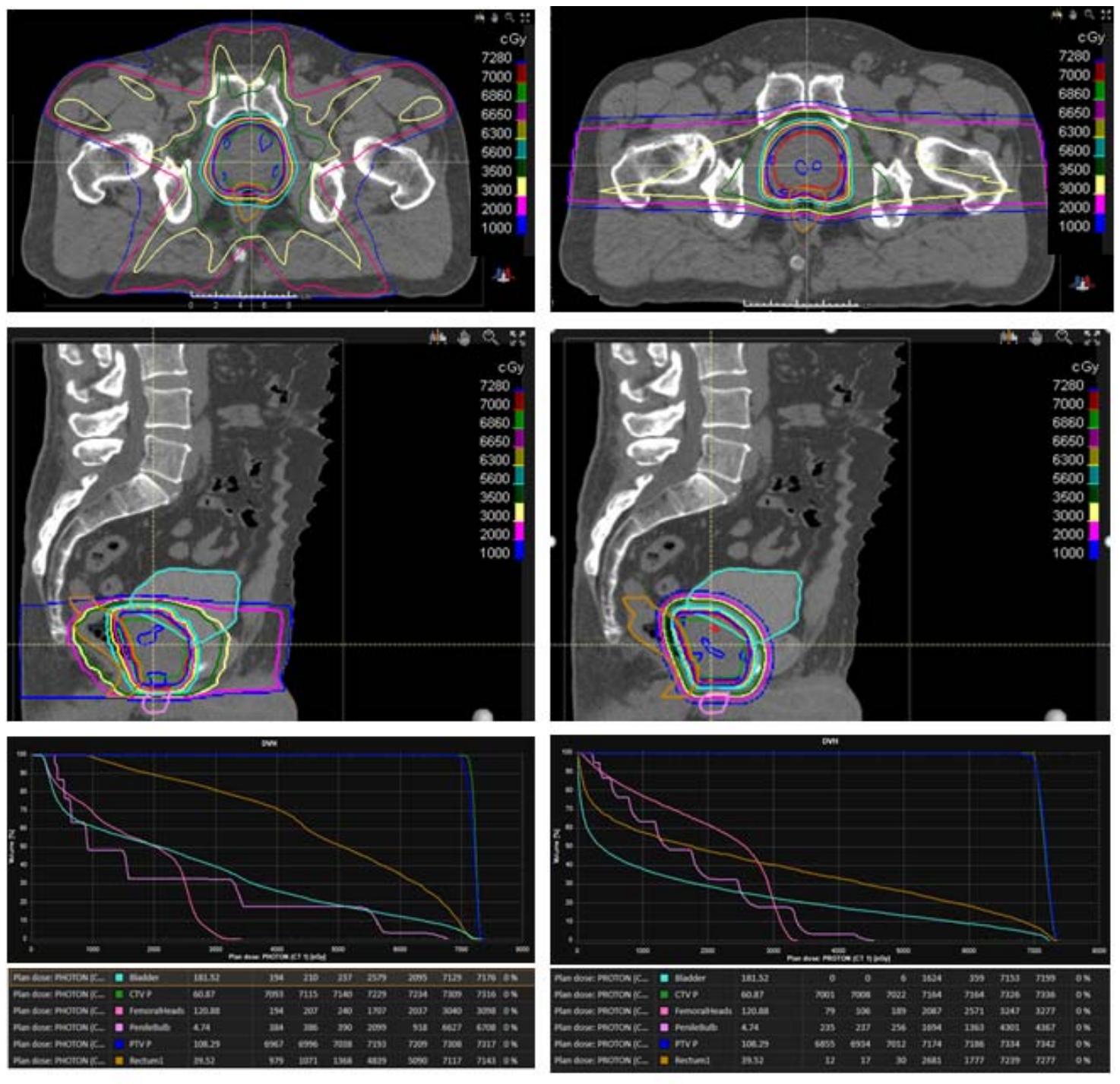 image_category: MEDICAL_IMAGING/Radiotherapy Treatment Plan Comparison | body_region: pelvis | specialty: Radiation Oncology | summary: Comparison of photon-based and proton-based radiotherapy plans for prostate cancer, demonstrating superior dose sparing of organs at risk with proton therapy. | detail: The image displays a comprehensive comparison between two radiotherapy modalities for prostate cancer: Photon therapy (left column) and Proton therapy (right column). The top four panels show axial and sagittal CT slices overlaid with isodose distributions. The photon plan exhibits a characteristic 'low-dose bath,' with the 1000-3500 cGy isodose lines (blue and yellow) spreading widely across the pelvic cavity and through the femoral heads. In contrast, the proton plan shows highly conformal dose distribution, with a sharp dose fall-off and significant sparing of the lateral pelvic tissues and femoral heads due to the Bragg peak effect. The bottom panels contain Dose-Volume Histograms (DVH) and corresponding data tables. The DVH curves illustrate that while target coverage (PTV P and CTV P) remains consistent between both plans, the proton plan (right) significantly reduces the volume of the bladder and rectum receiving low-to-intermediate doses. Specifically, the tables show that for the femoral heads, the photon plan delivers doses ranging from 194 to 3098 cGy across various volume percentiles, whereas the proton plan reduces these values to nearly zero in the low-dose range (79-3277 cGy). This reduction in integral dose is clinically significant for minimizing long-term toxicities and the risk of secondary malignancies. | entities: diseases=Prostate cancer; anatomical_structures=Bladder, Rectum, Femoral Heads, Penile bulb, Prostate, CTV P, PTV P; interventions=Radiotherapy, Proton Therapy, Photon Therapy, IMRT, Treatment Planning; findings=Isodose lines: 7280, 7000, 6860, 6650, 6300, 5600, 3500, 3000, 2000, 1000 cGy, Photon plan shows wider low-dose distribution, Proton plan shows superior sparing of femoral heads, DVH curves show steep gradient for PTV in both plans | measurements: Prescription Dose 7280 cGy; Bladder Volume 181.52 cc; CTV P Volume 60.87 cc; Femoral Heads Volume 120.88 cc; PTV P Volume 108.29 cc