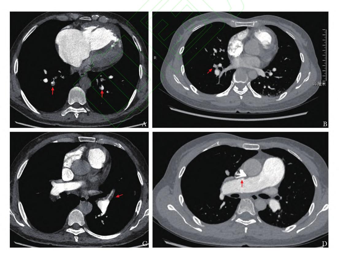 【增强CT/肺动脉造影(CTPA)】多发性肺栓塞CTPA影像
