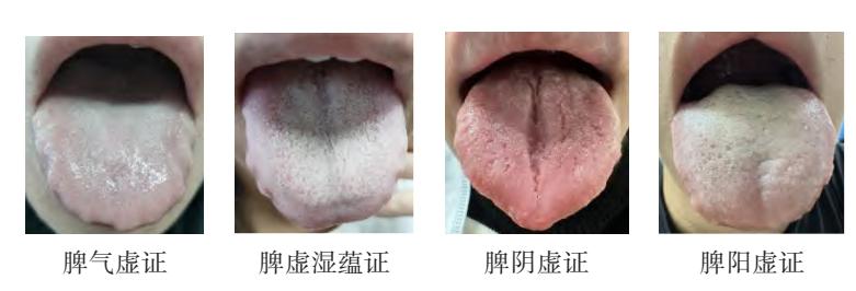 image_category: CLINICAL_PHOTO/中医舌象图 | body_region: 头 | specialty: 中医科 | summary: 展示了中医脾虚证四种典型亚型(气虚、湿蕴、阴虚、阳虚)的临床舌象特征。