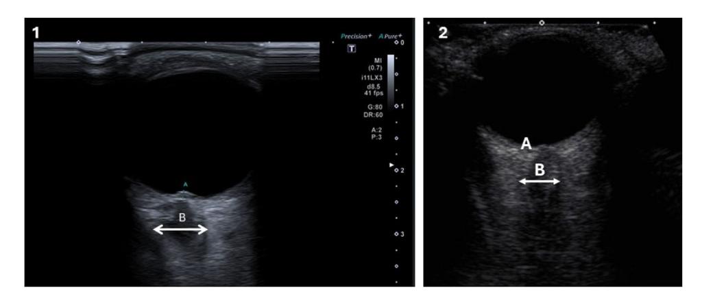 【NCCN Clinical Practice Guidelines: Non-Small Cell Lung Cancer】TNM Staging for Lung Cancer