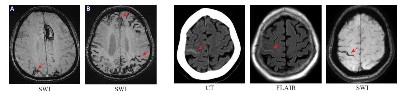 image_category: MEDICAL_IMAGING/MRI/CT多模态影像 | body_region: 头 | specialty: 神经内科 | summary: 多模态影像显示皮质浅表铁沉积(cSS)及微出血,提示脑淀粉样血管病(CAA)。