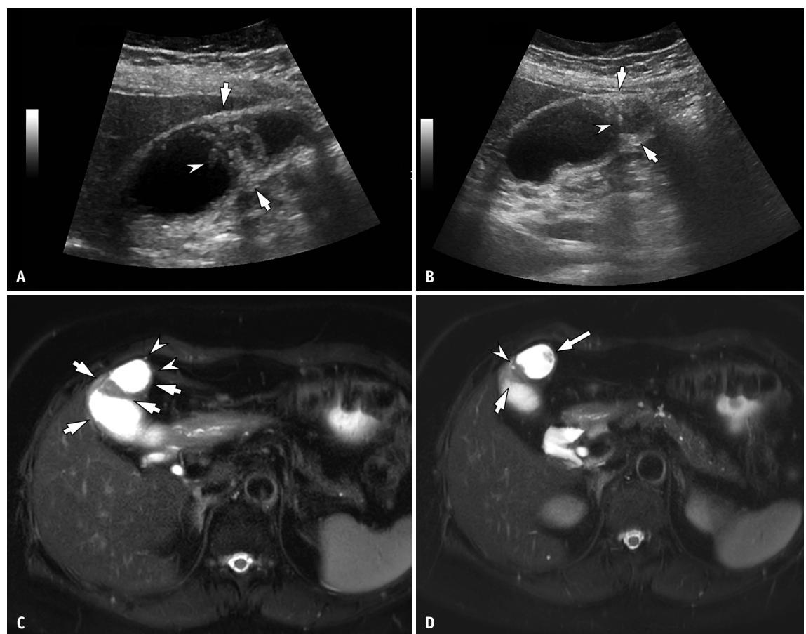 【Interpretation, Reporting, Imaging-Based Workups, and Surveillance of Incidentally Detected Gallbladder Polyps and Gallbladder Wall Thickening: 2025 Recommendations From the Korean Society of Abdominal Radiology】Ultrasound and MRI