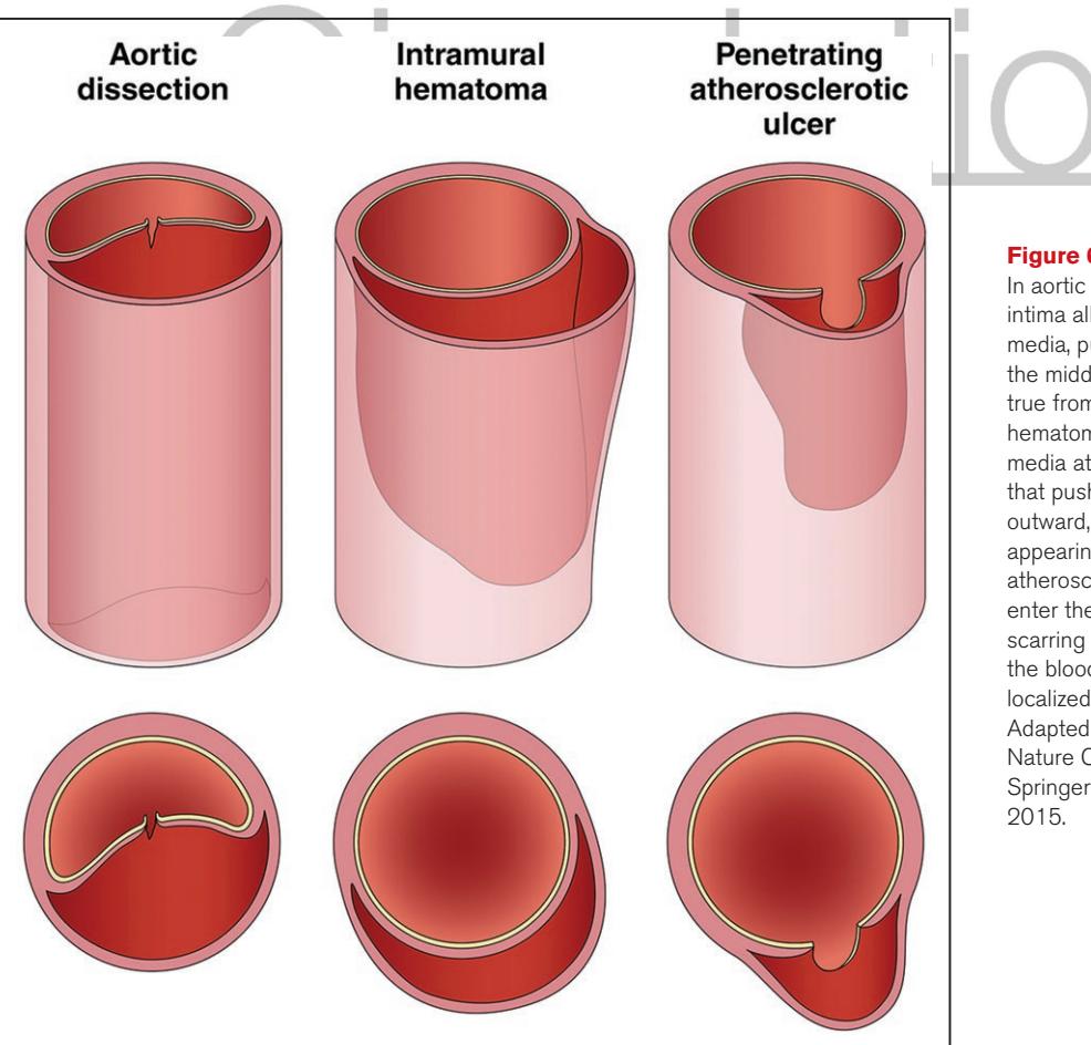 image_category: DIAGRAM/Medical Illustration of Acute Aortic Syndromes | body_region: chest | specialty: Cardiology | summary: A comparative anatomical illustration detailing the three primary types of acute aortic syndromes: aortic dissection, intramural hematoma, and penetrating atherosclerotic ulcer.