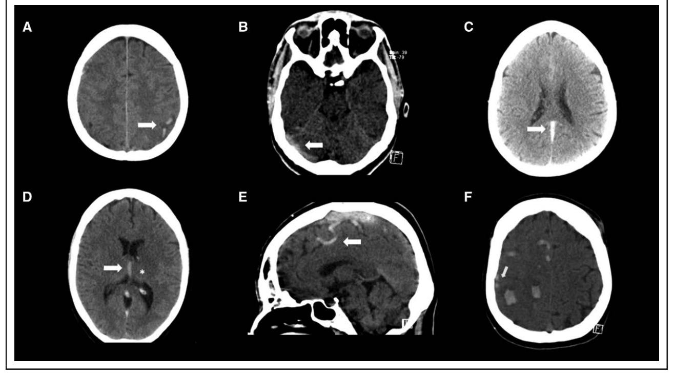 【Diagnosis and Management of Cerebral Venous Thrombosis: A Scientific Statement From the American Heart Association】Non-contrast CT (NCCT)