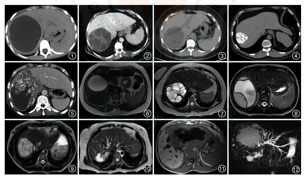 【肝包虫病影像学诊断专家共识】CT/MRI/MRCP