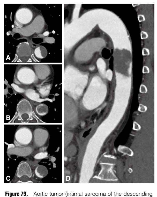 【 JCS/JSCVS/JATS/JSVS 2020 Guideline on Diagnosis and Treatment of Aortic Aneurysm and Aortic Dissection】Classification flowchart of aortic intimal sarcoma