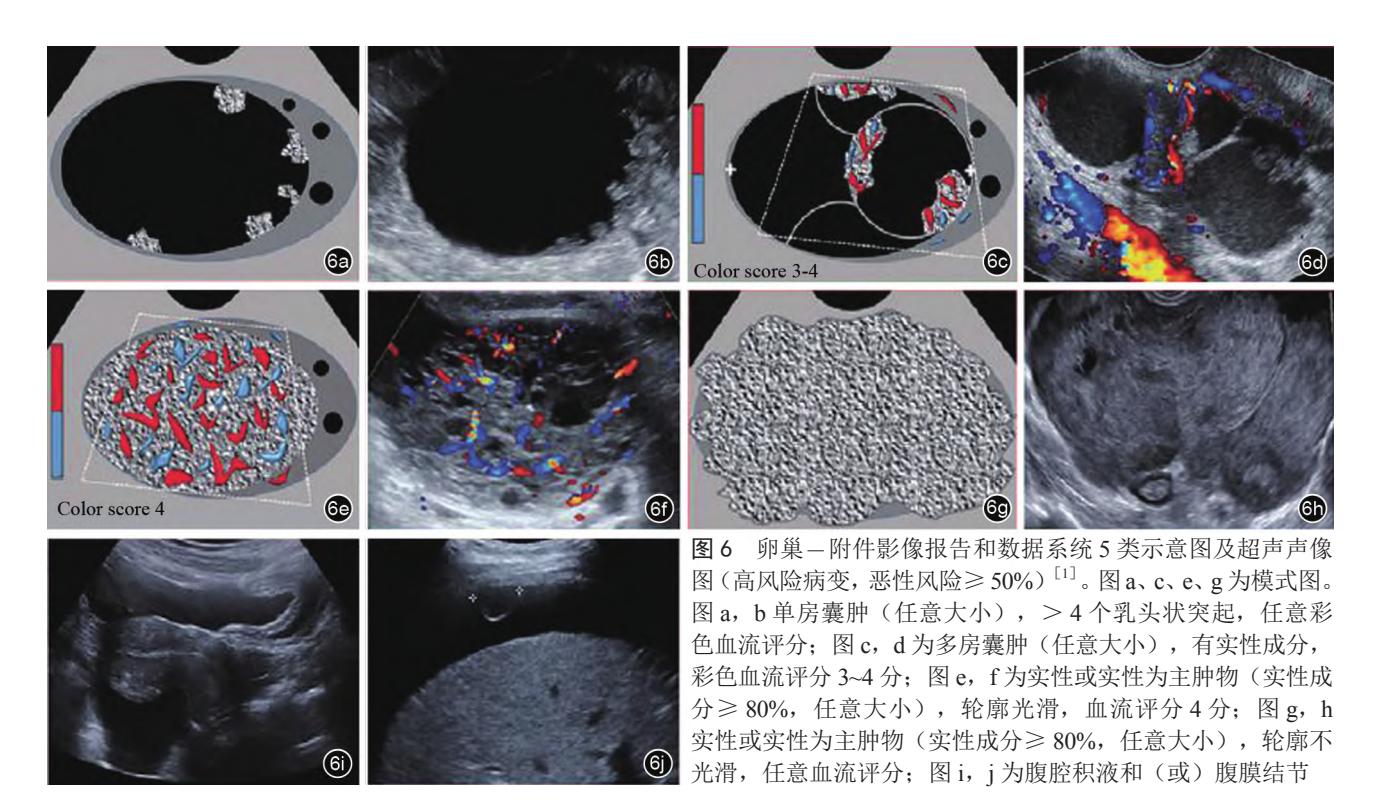 【MEDICAL_IMAGING/超声影像】O-RADS 5类高风险病变超声特征图