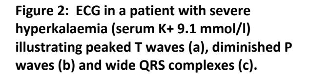【UKKA Guideline】ECG findings in severe hyperkalaemia