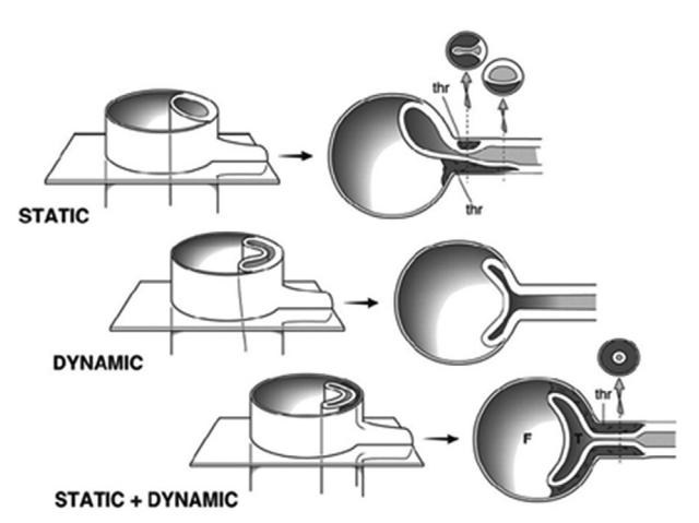 image_category: DIAGRAM/Schematic diagram of aortic dissection mechanisms | body_region: chest | specialty: Vascular Surgery | summary: Schematic illustration of static, dynamic, and combined mechanisms of true lumen obstruction in aortic dissection.
