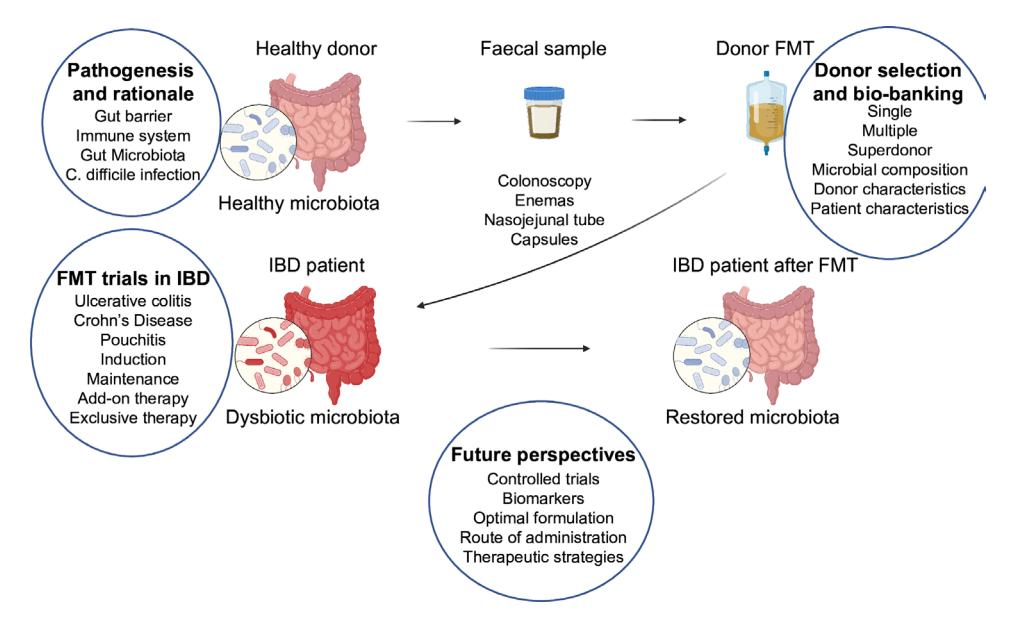 【Rome Consensus Conference】Fecal Microbiota Transplantation (FMT) workflow for IBD