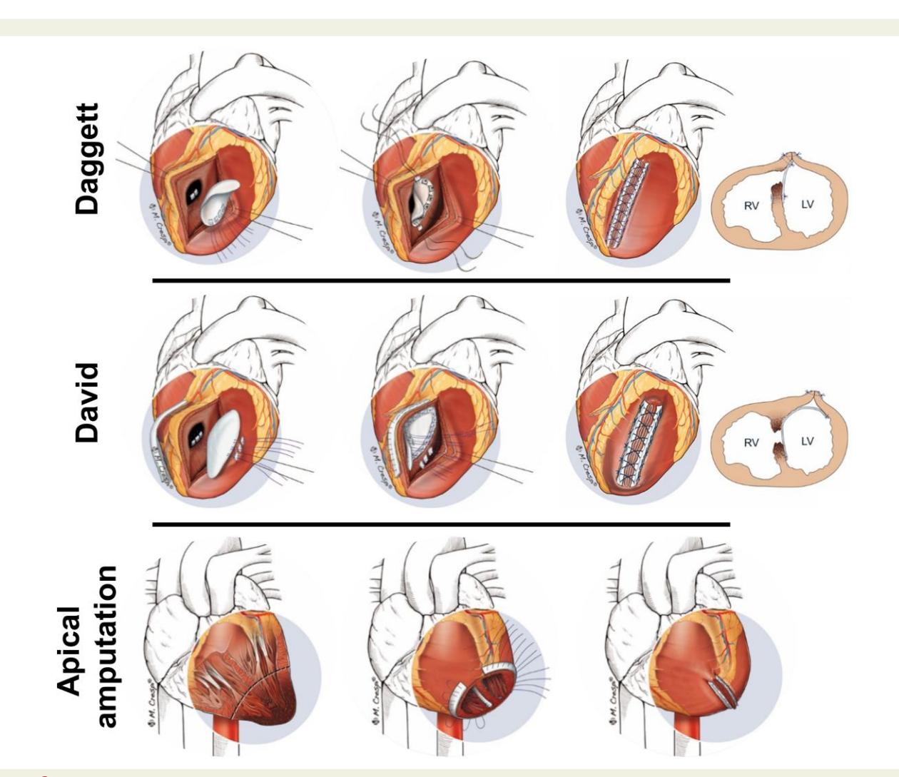 【Ventricular septal defect complicating acute myocardial infarction: diagnosis and management. A Clinical Consensus Statement of the Association for Acute CardioVascular Care (ACVC) of the ESC, the European Association of Percutaneous Cardiovascular Interv】Surgical technique illustration