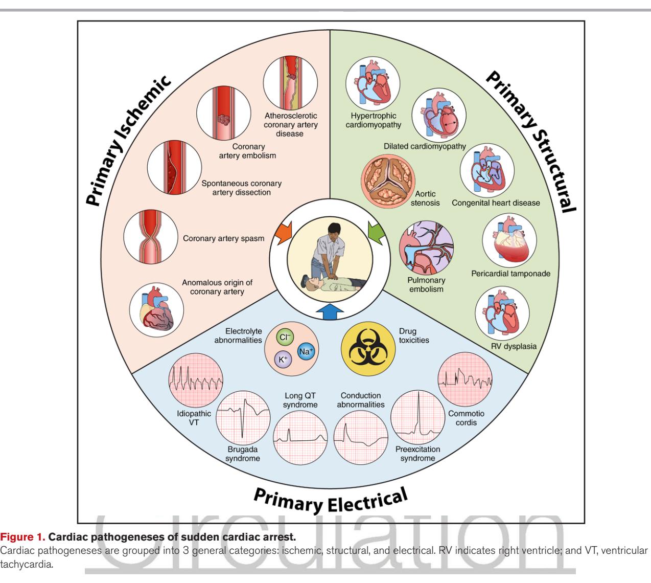 【Goldberger’s Clinical electrocardiography, A simplified approach】Sudden Cardiac Arrest Pathogenesis Diagram