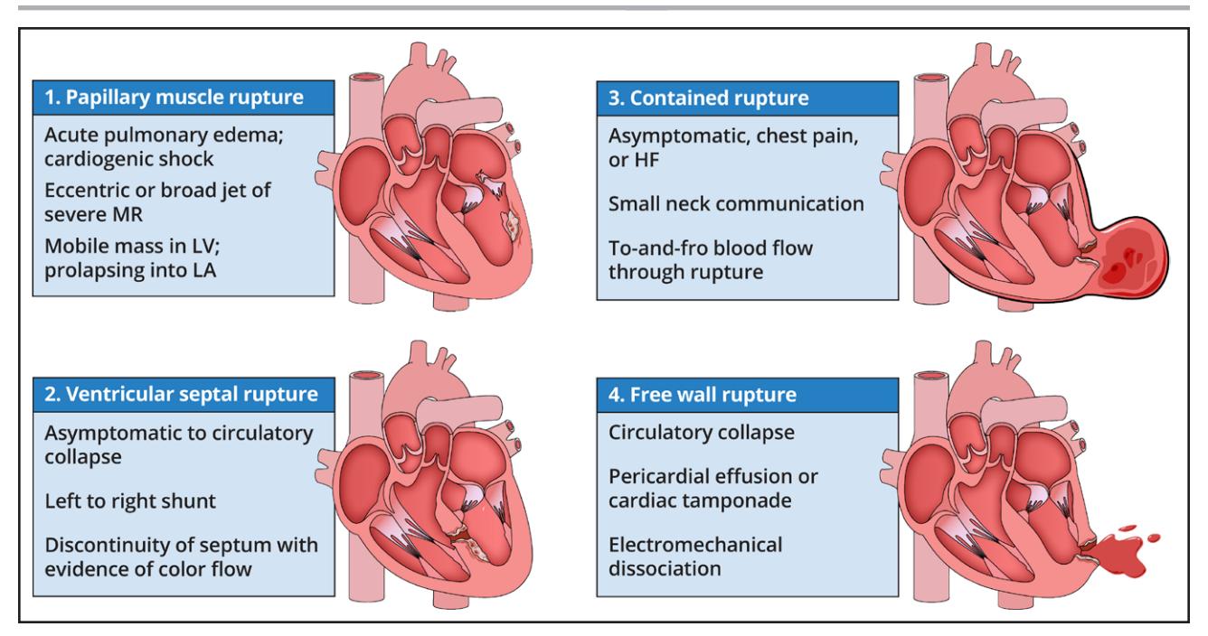【2025 ACC/AHA/ACEP/NAEMSP/SCAI Guideline for the Management of Patients With Acute Coronary Syndromes】Clinical Characteristics of Mechanical Complications of Acute Myocardial Infarction