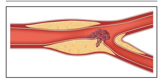 image_category: DIAGRAM/Medical illustration of arterial plaque rupture and thrombosis