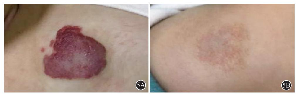 【硬化注射治疗血管瘤专家共识】婴儿血管瘤治疗前后对比