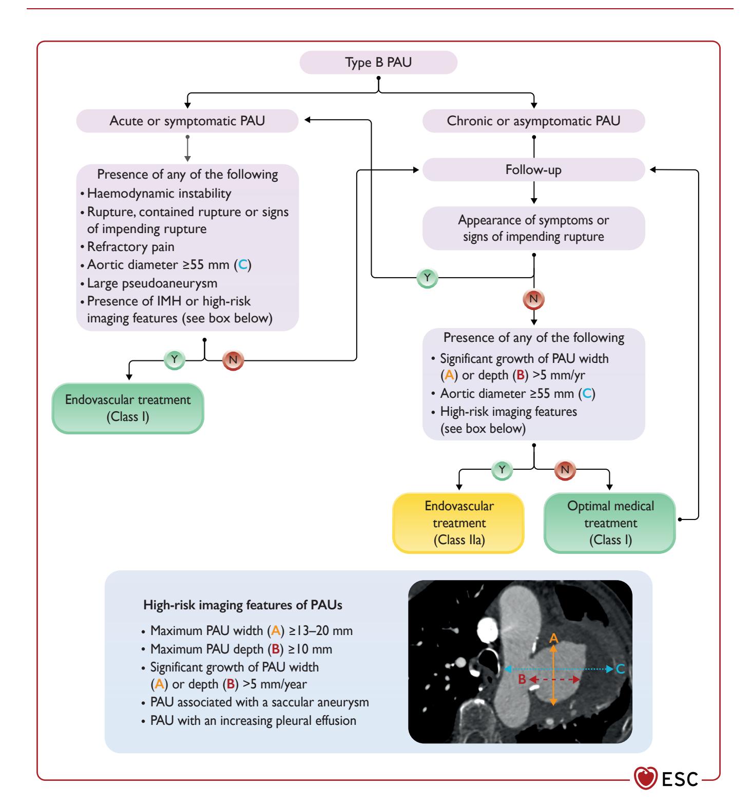 【2024 ESC Guidelines for the management of peripheral arterial and aortic diseases】Type B PAU Management Algorithm