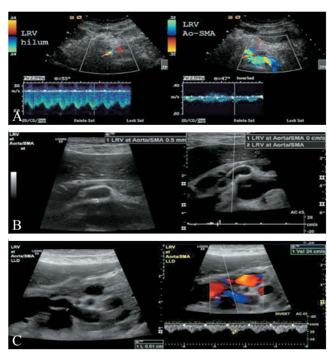 【International union of angiology consensus document on vascular compression syndromes】Doppler Ultrasound