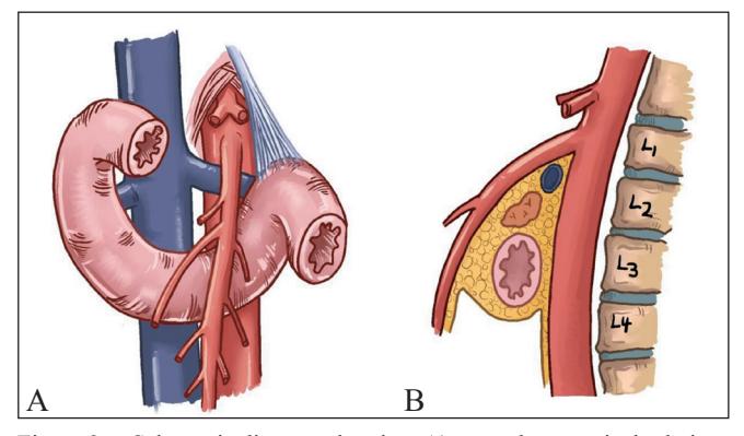 【International union of angiology consensus document on vascular compression syndromes】Anatomical illustration