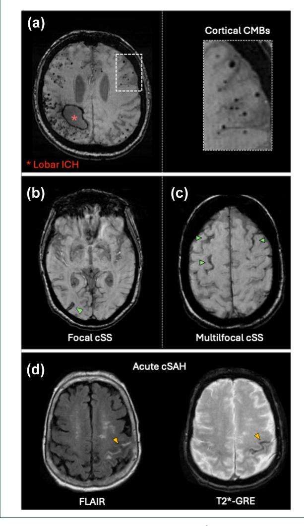 image_category: MEDICAL_IMAGING/MRI | body_region: head | specialty: Radiology | summary: MRI findings illustrating the spectrum of hemorrhagic markers in cerebral amyloid angiopathy, including lobar ICH, microbleeds, superficial siderosis, and acute subarachnoid hemorrhage.