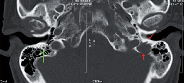 多发性骨髓瘤骨病的影像学及治疗进展