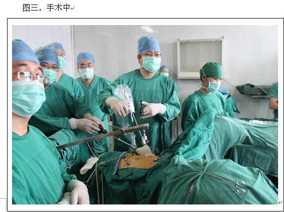 齐鲁医院成功实施国际首例单孔腹腔镜直肠癌根治术（Miles 术式）