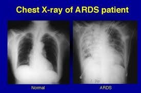 Lancet：沙丁胺醇增加ARDS患者死亡率
