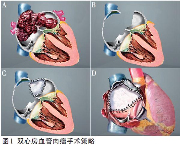 心脏肿瘤外科治疗技巧