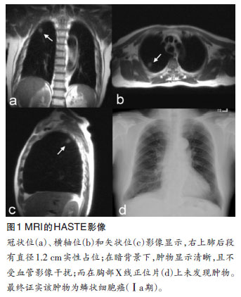 BMC Cancer:零放射剂量MRI行肺癌普查