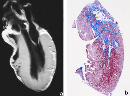 Lancet：心脏MRI检查优于SPECT