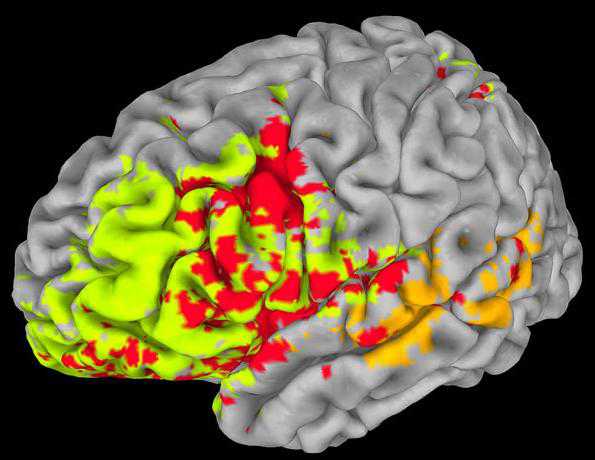 Brain：脑损伤数据绘制大脑智力图谱