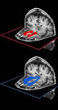 J Neurosci：脑白质影响我们做决定