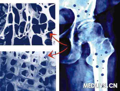 Nat rev2011内分泌研究进展：骨质疏松症的治疗