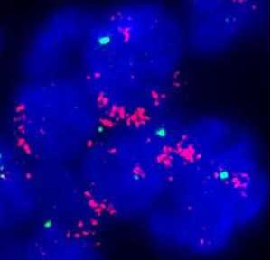 Nature：研究者发现新的黑色素瘤突变基因-PREX2