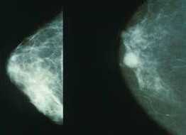 PRSBBS：消失的乳腺癌基因之谜