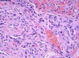 Cancer Res：科学家发现驱动恶性肿瘤生长和存在的关键激酶