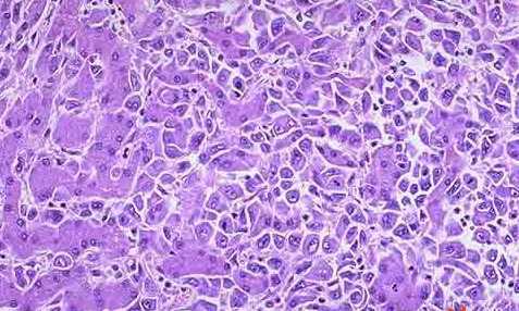 JCI：顾建新研究组发现核糖体蛋白能够促进肝细胞癌的化疗耐药及生长