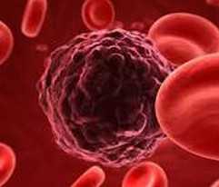 Blood：荟萃分析显示II型糖尿病患者或更易患血液肿瘤