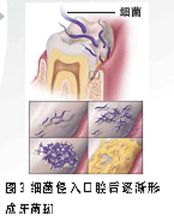 BMJ：口腔卫生或与<font color="red">癌症</font><font color="red">死亡率</font>升高相关
