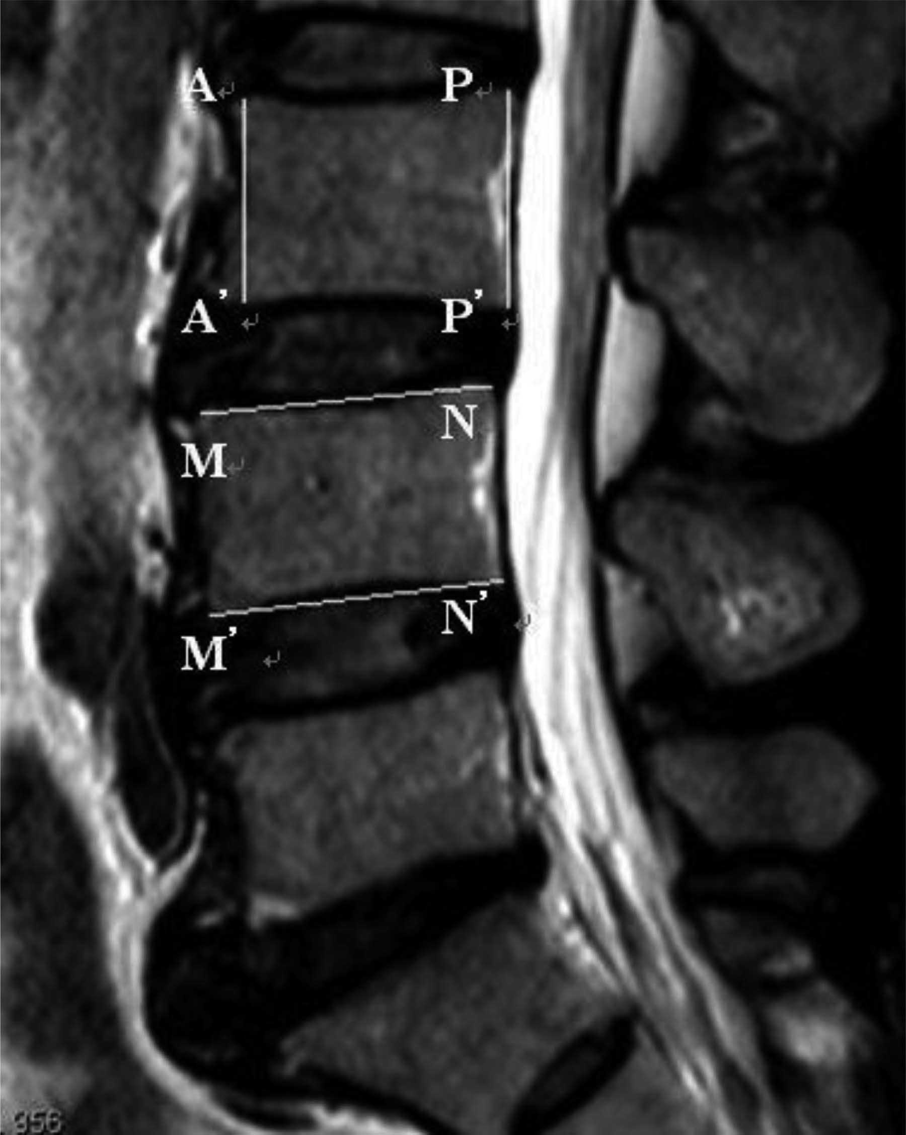 第四节 椎间盘退行性变-腰椎疾病比较影像学-医学