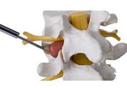 椎间孔镜TESSYS技术治疗腰椎间盘突出症