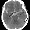 BMC Neurosci:右脑额下回<font color="red">镜像</font>神经元障碍或导致自闭症